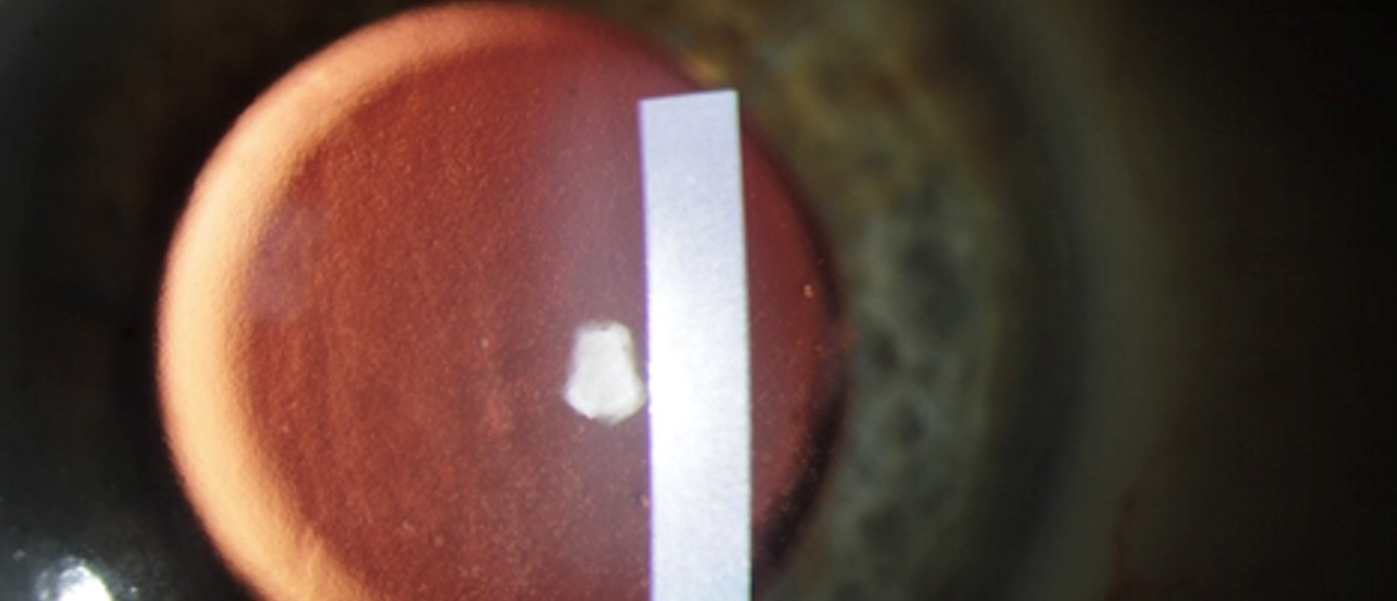 Fuchs Endothelial Corneal Dystrophy