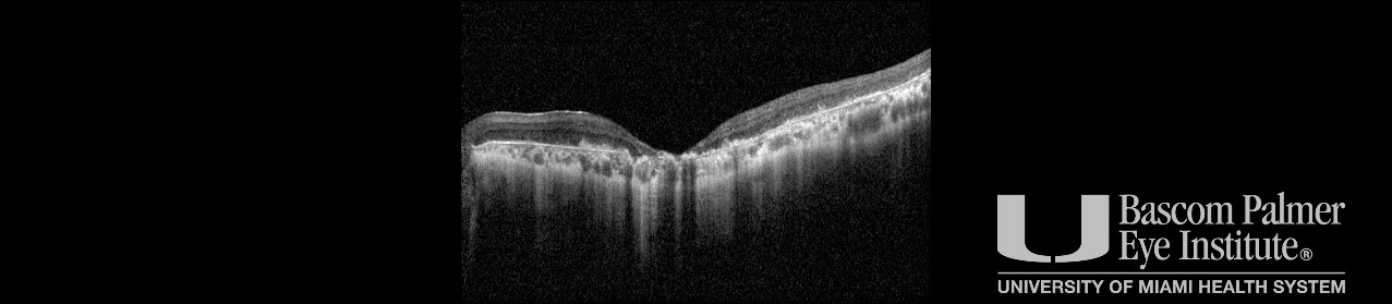 Stargardt Disease