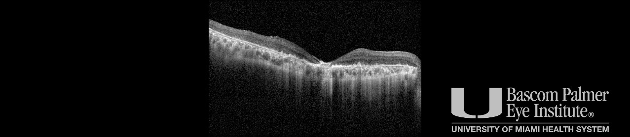 Stargardt Disease