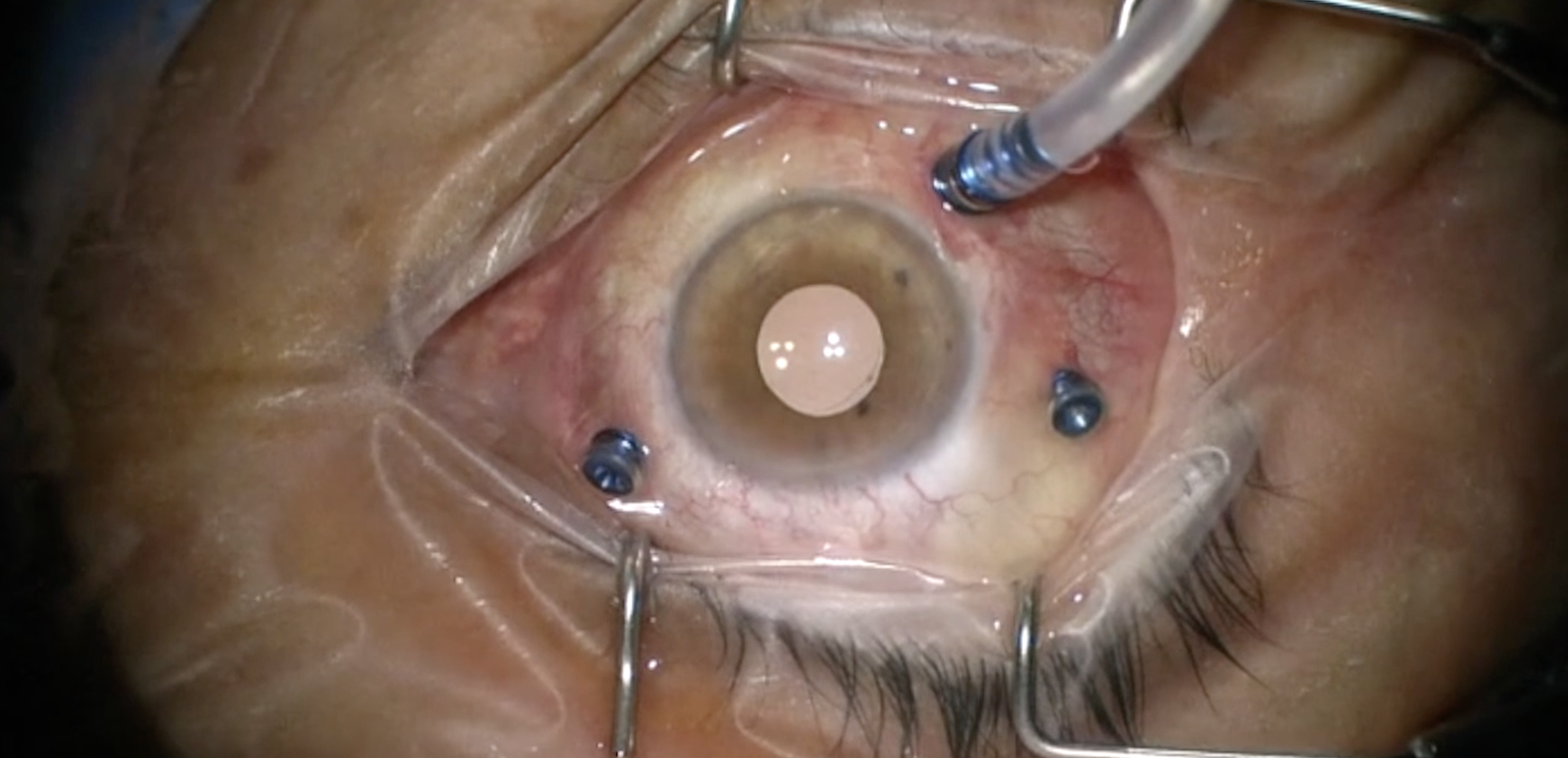 Submacular Hemorrhage