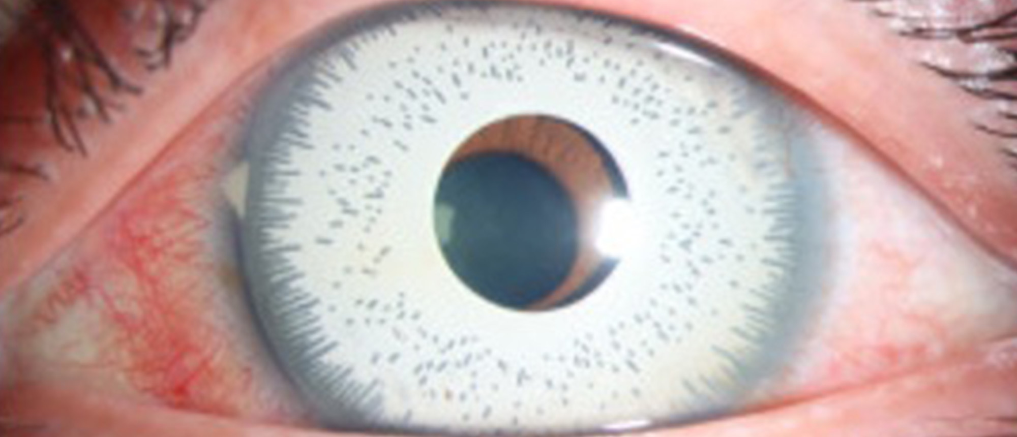 Corneal Edema and Secondary Angle Closure Glaucoma Due to Cosmetic Iris Implants