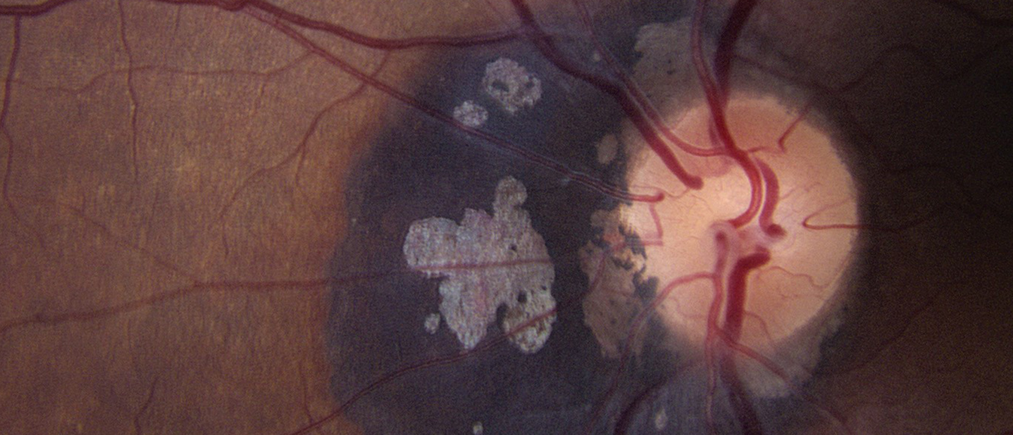 Peripapillary Congenital Hypertrophy of the Retinal Pigment Epithelium (CHRPE)