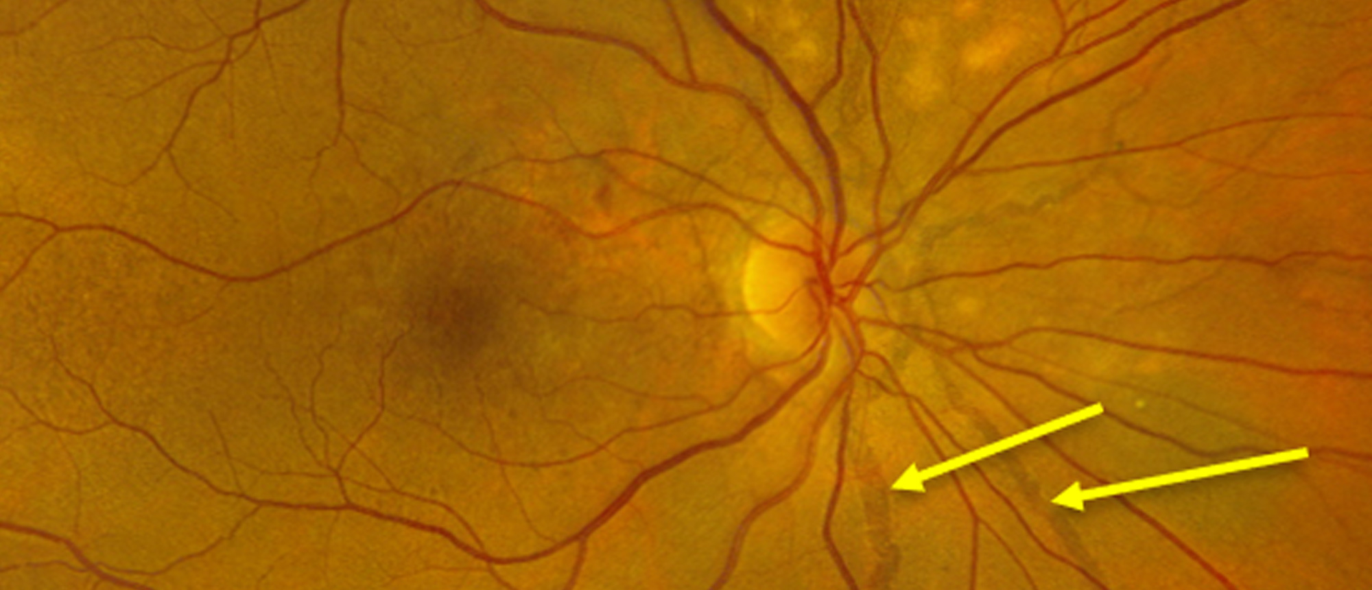 Pseudoxanthoma Elasticum with Angioid Streaks