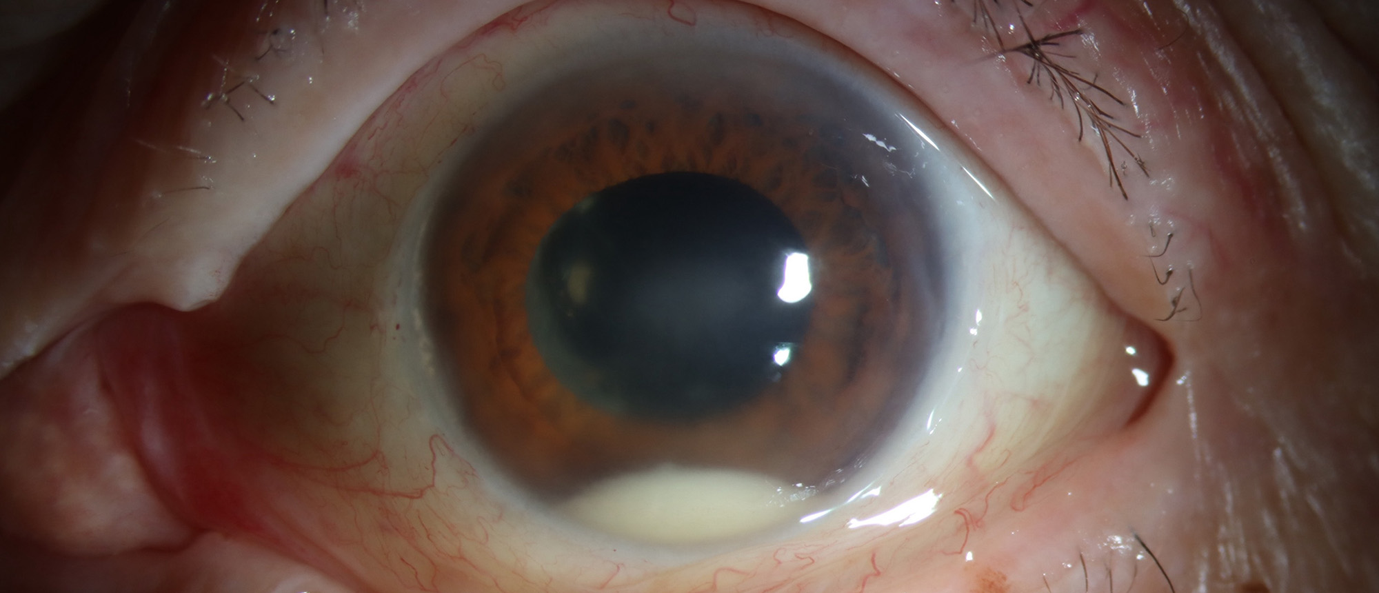 Muckle-Wells Syndrome