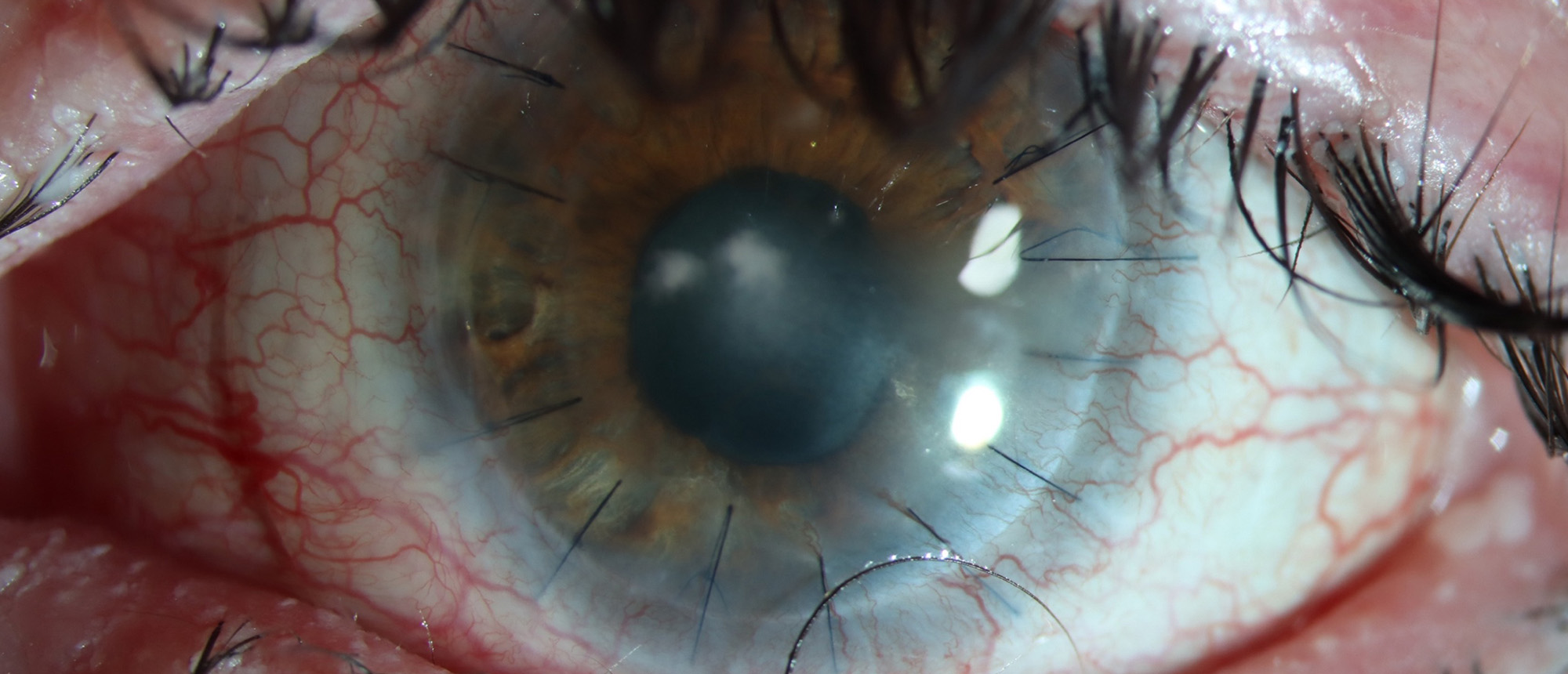 Candida Albicans Keratitis