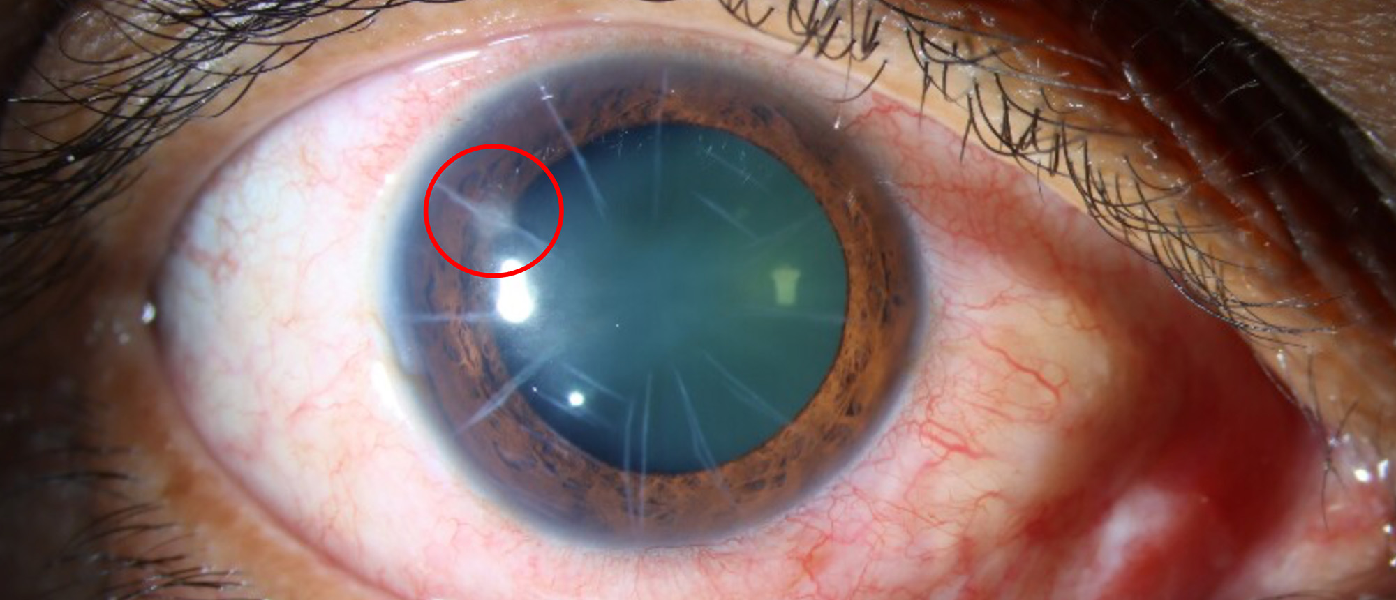 Radial Keratotomy Associated Corneal Ulcer