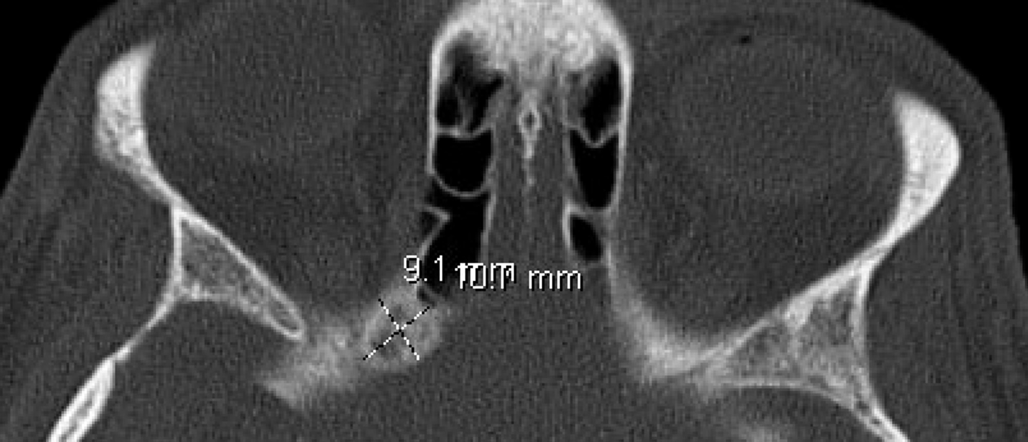 Complications of Titanium Mesh Floor Implant