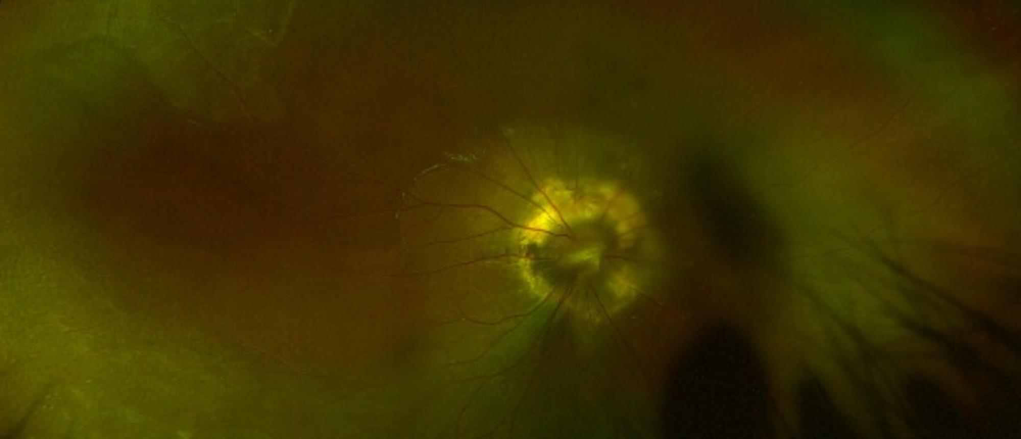 Morning Glory Disc Anomaly