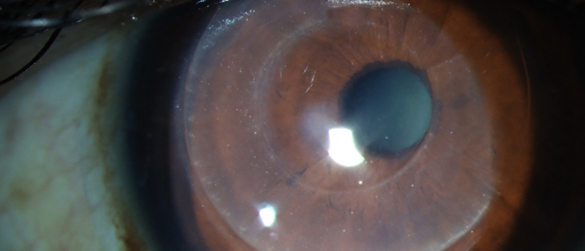 Corneal Tissue Addition Keratoplasty