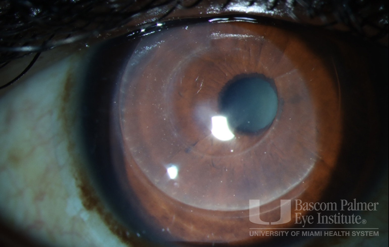 Corneal Tissue Addition Keratoplasty