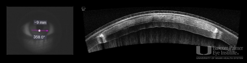 Corneal Tissue Addition Keratoplasty