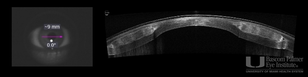 Corneal Tissue Addition Keratoplasty