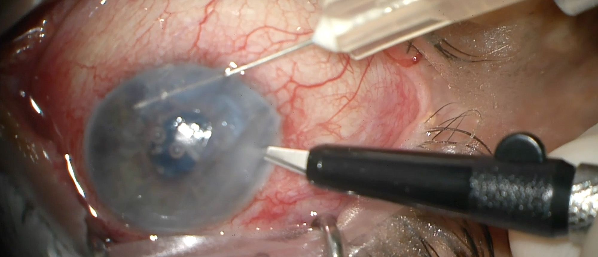 Tube Revision with Tube Extender