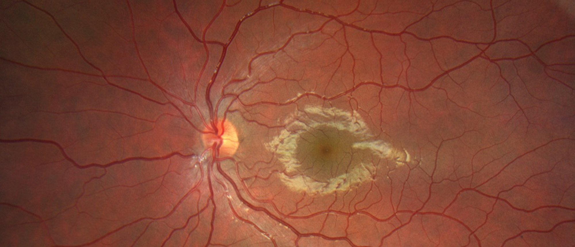 Traumatic Optic Neuropathy