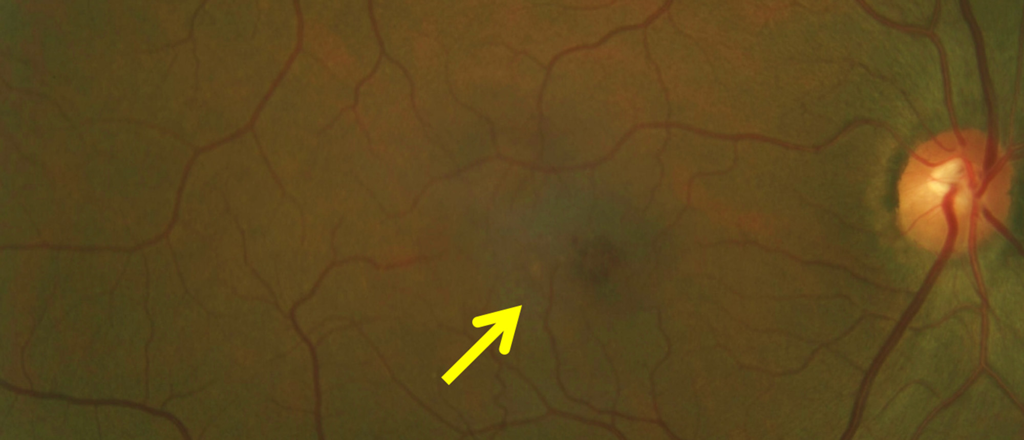 Macular Telangiectasia Type 2