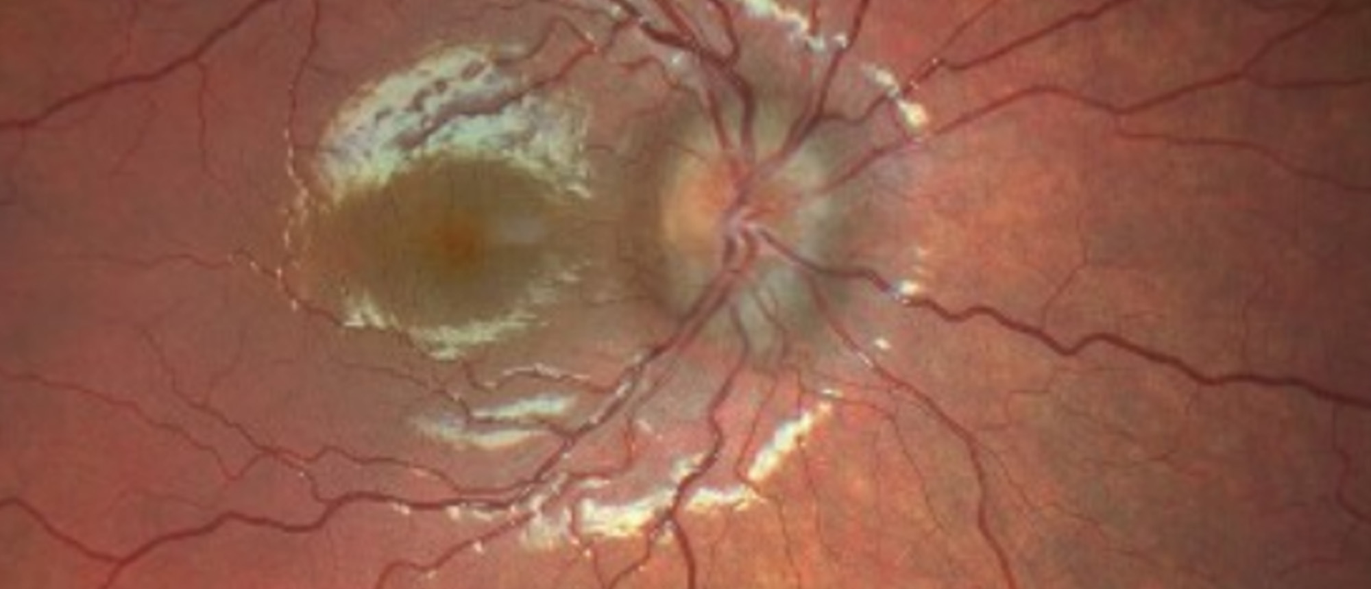 Pediatric Idiopathic Intracranial Hypertension (Pediatric IIH)