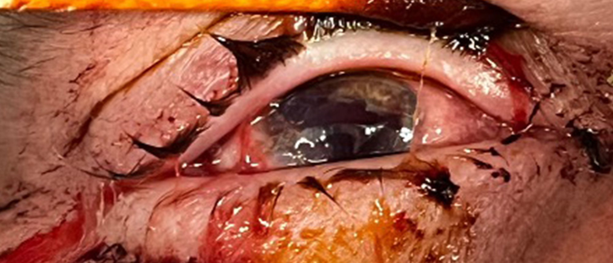 Intraocular Foreign Body