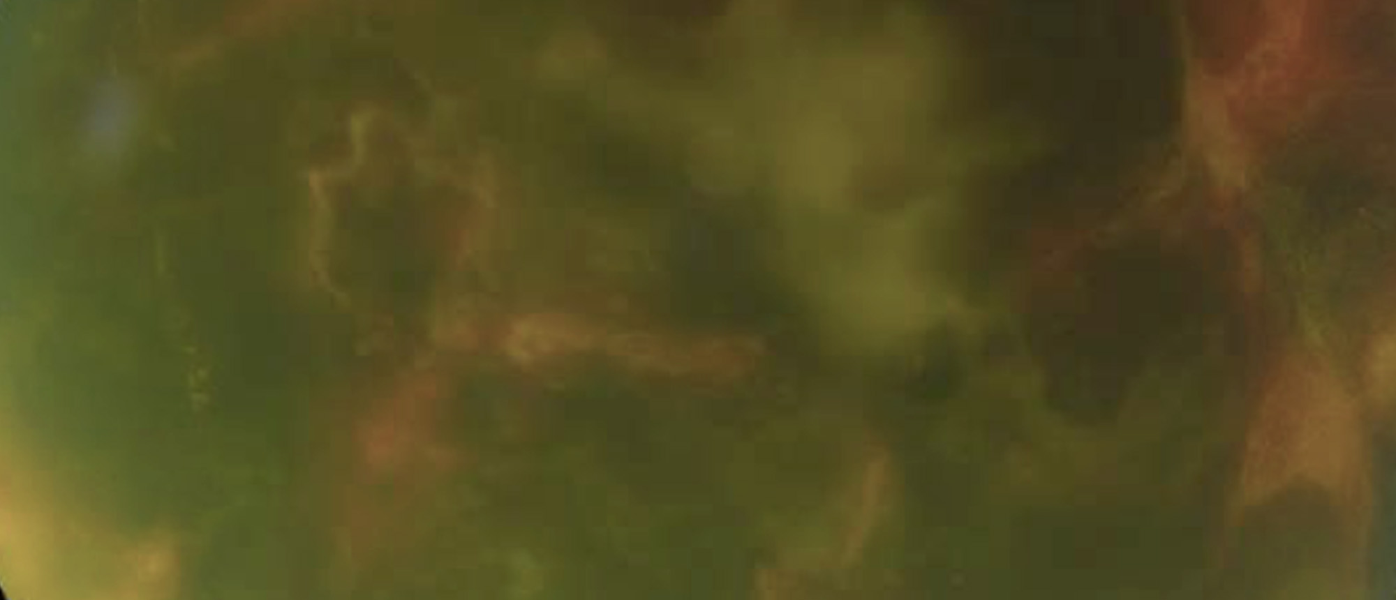 Diabetes Managed with Anterior Chamber Islet Cell Transplant