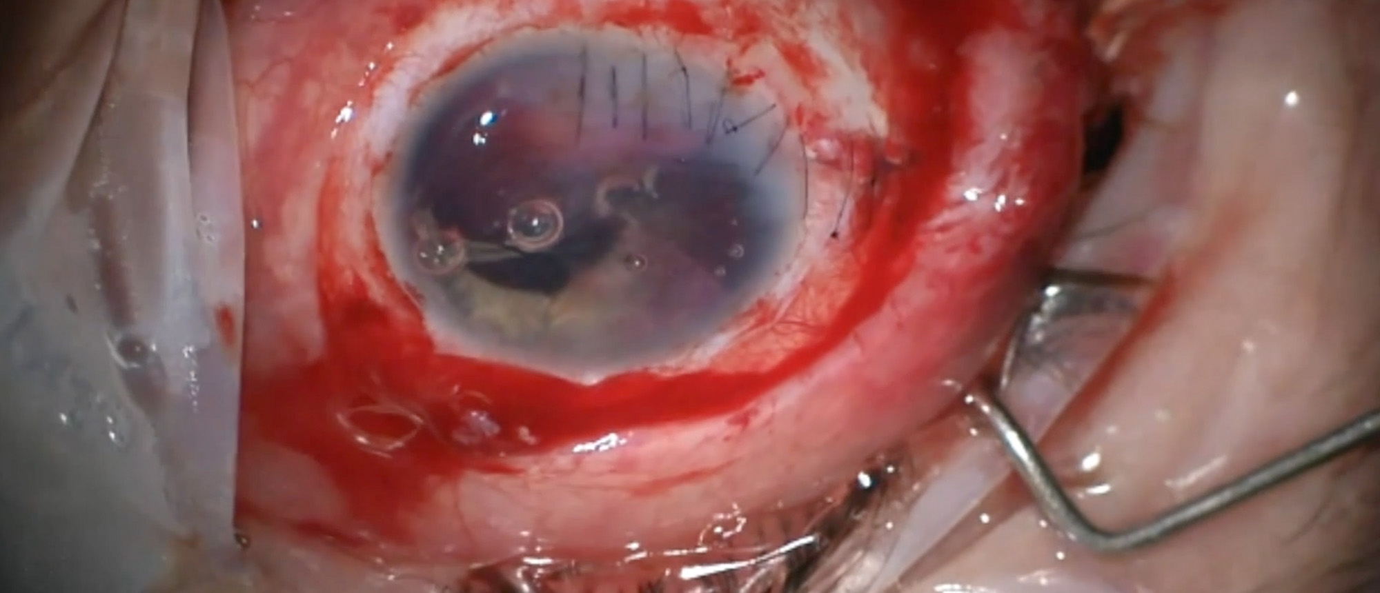 Intraocular Foreign Body