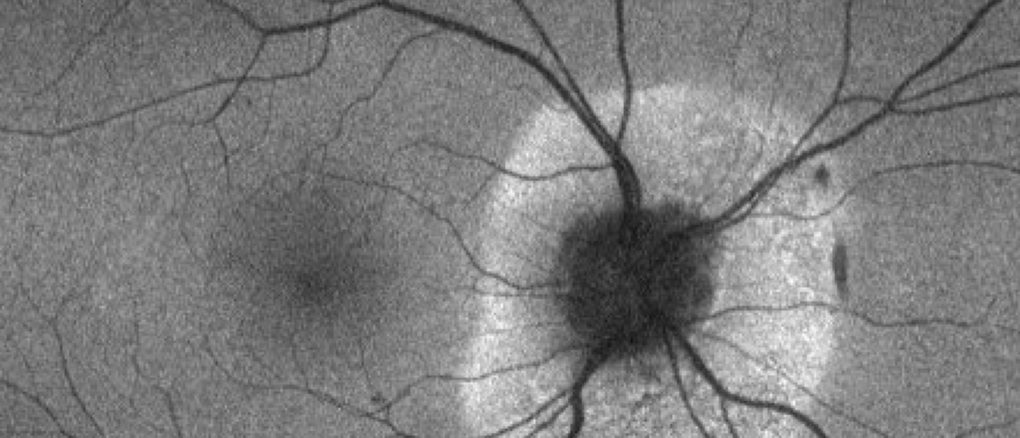 Peripapillary Subretinal Placoid Chorioretinopathy