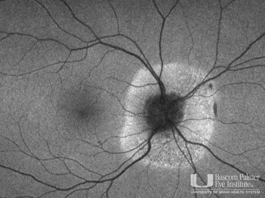 Peripapillary subretinal placoid chorioretinopathy