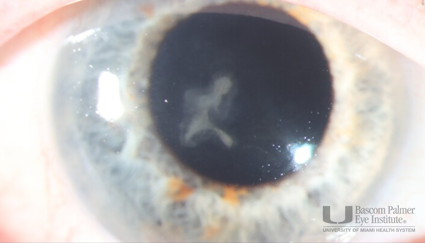 Central corneal scar