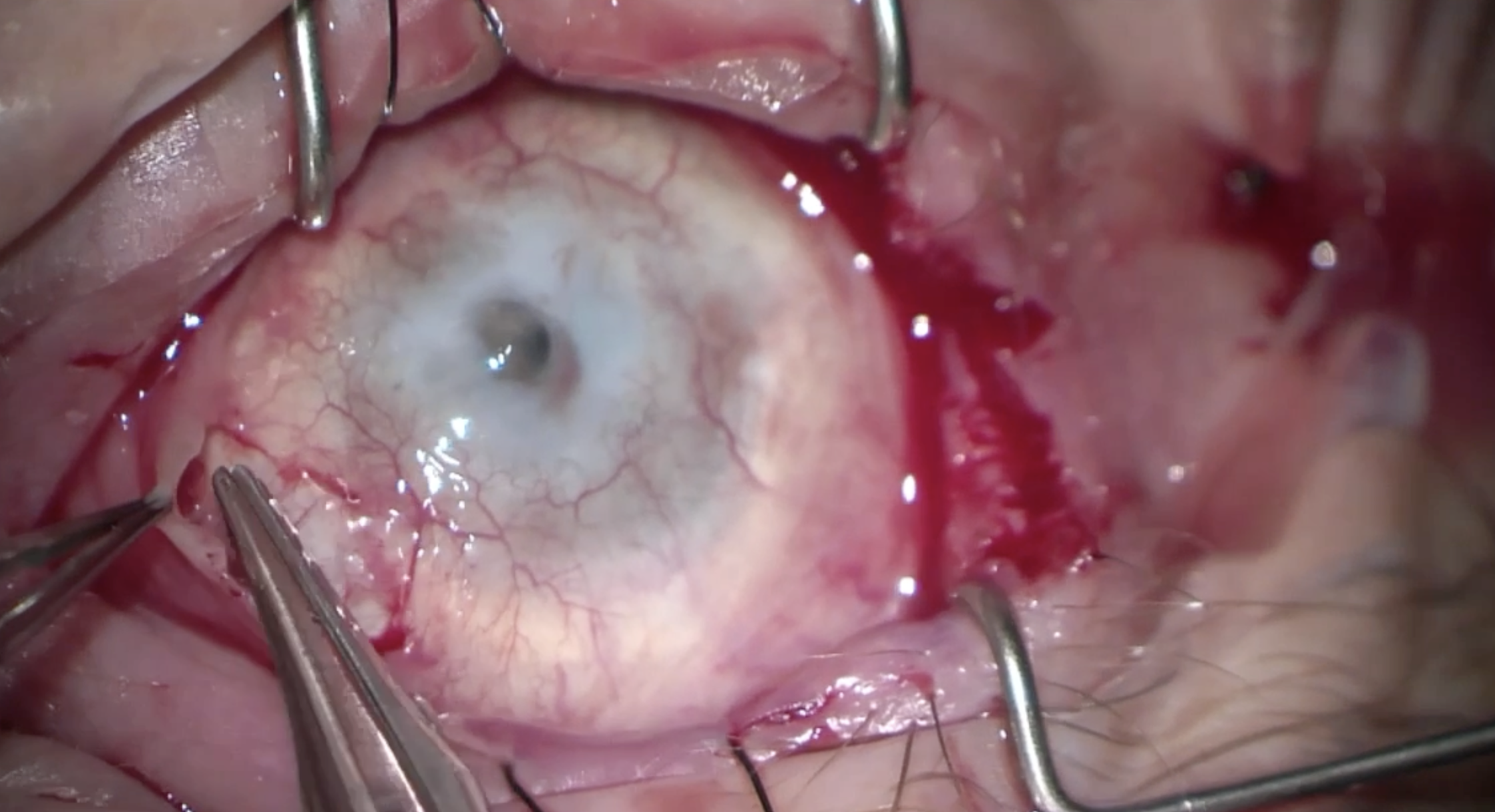 Descemet Membrane Anterior Keratoplasty