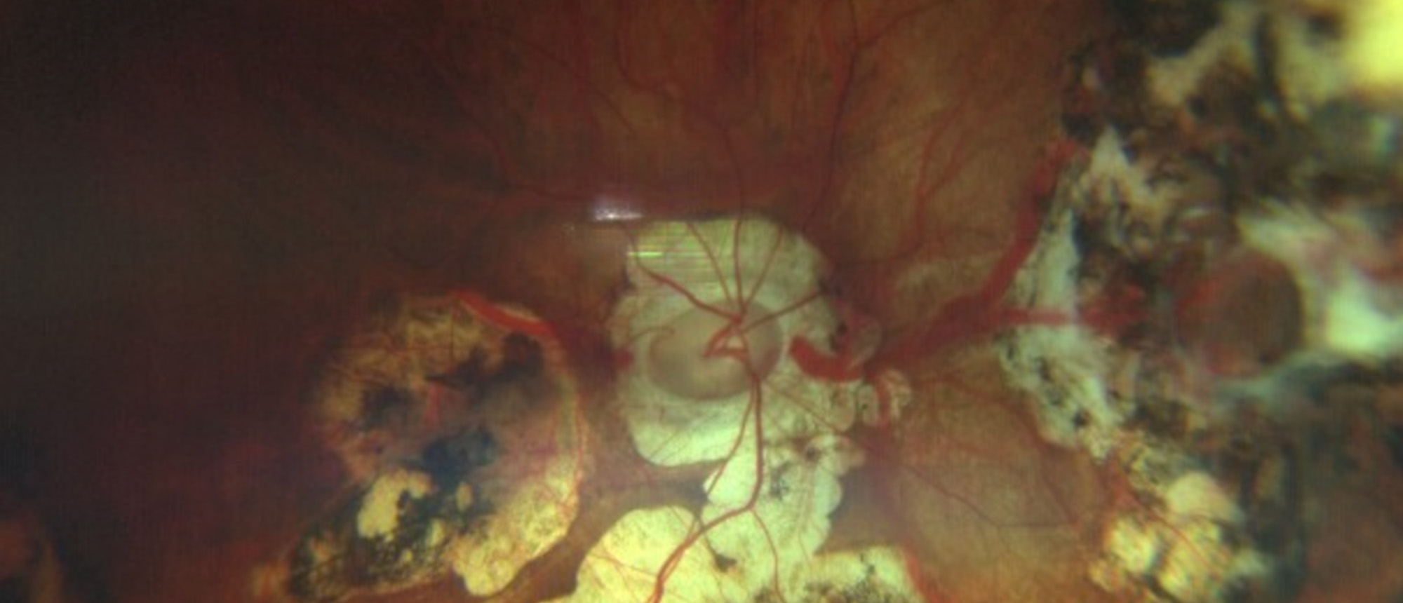 Peripapillary Intrachoroidal Cavitation