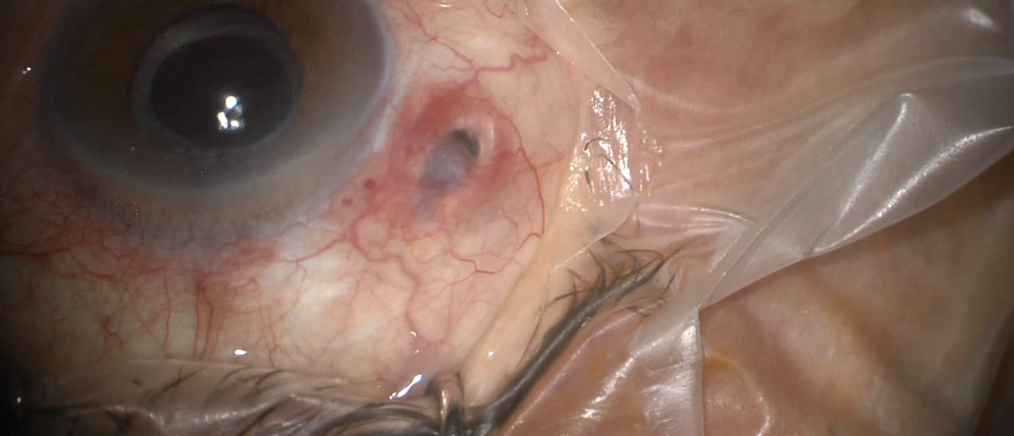 Ranibizumab Port Delivery System Exposure