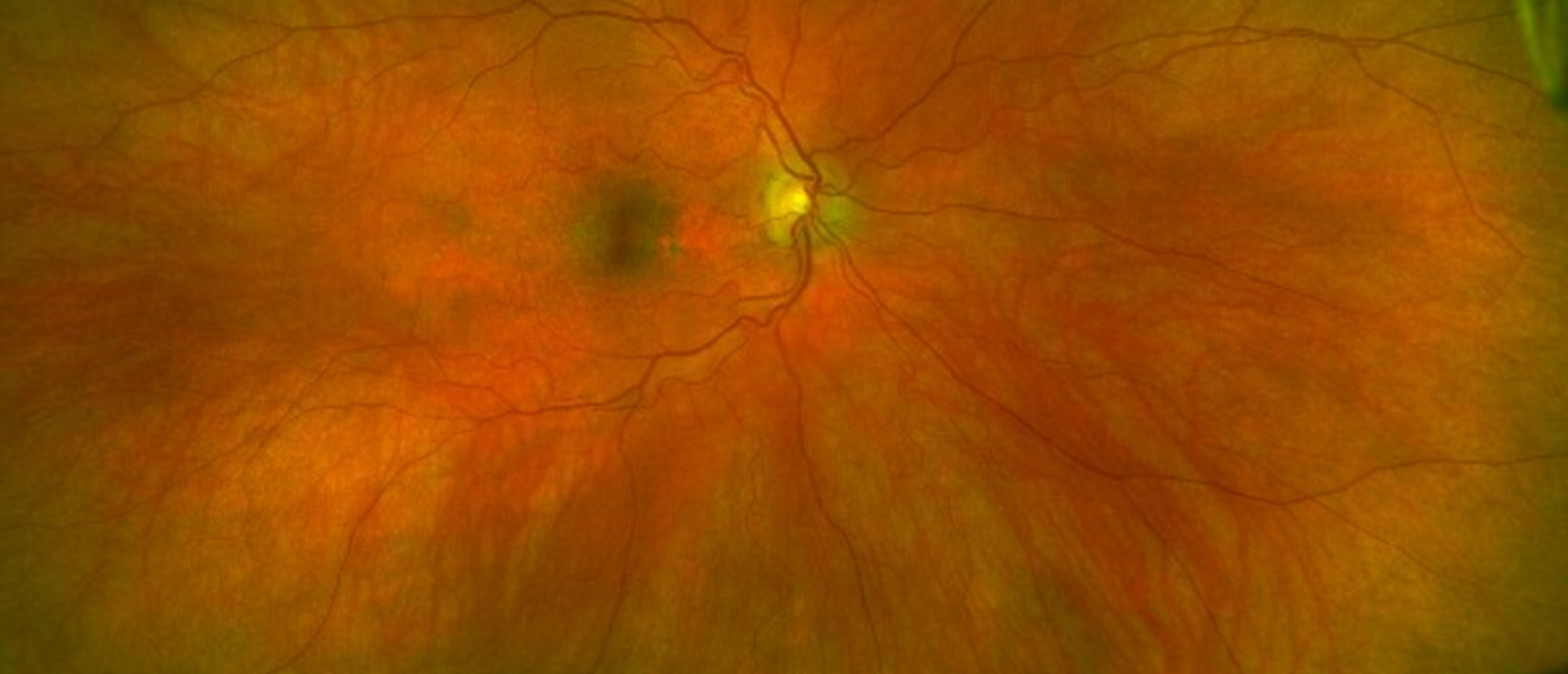 Maternally Inherited Diabetes and Deafness (MIDD)