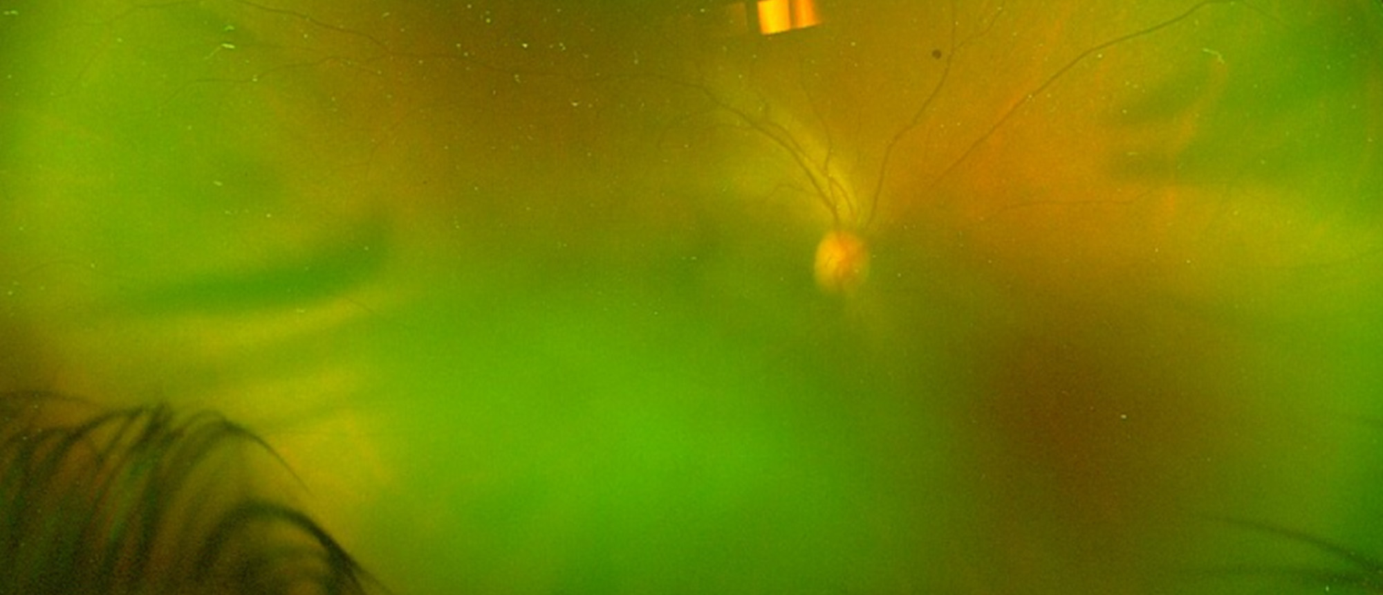 Secondary Intraocular NK/T-Cell Lymphoma