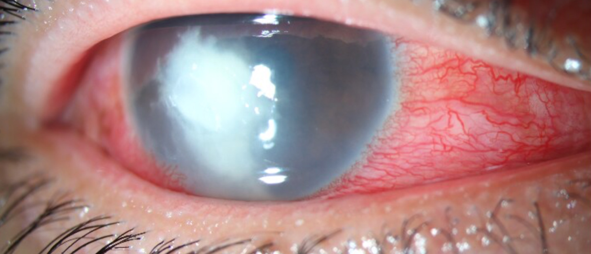Fusarium Keratitis