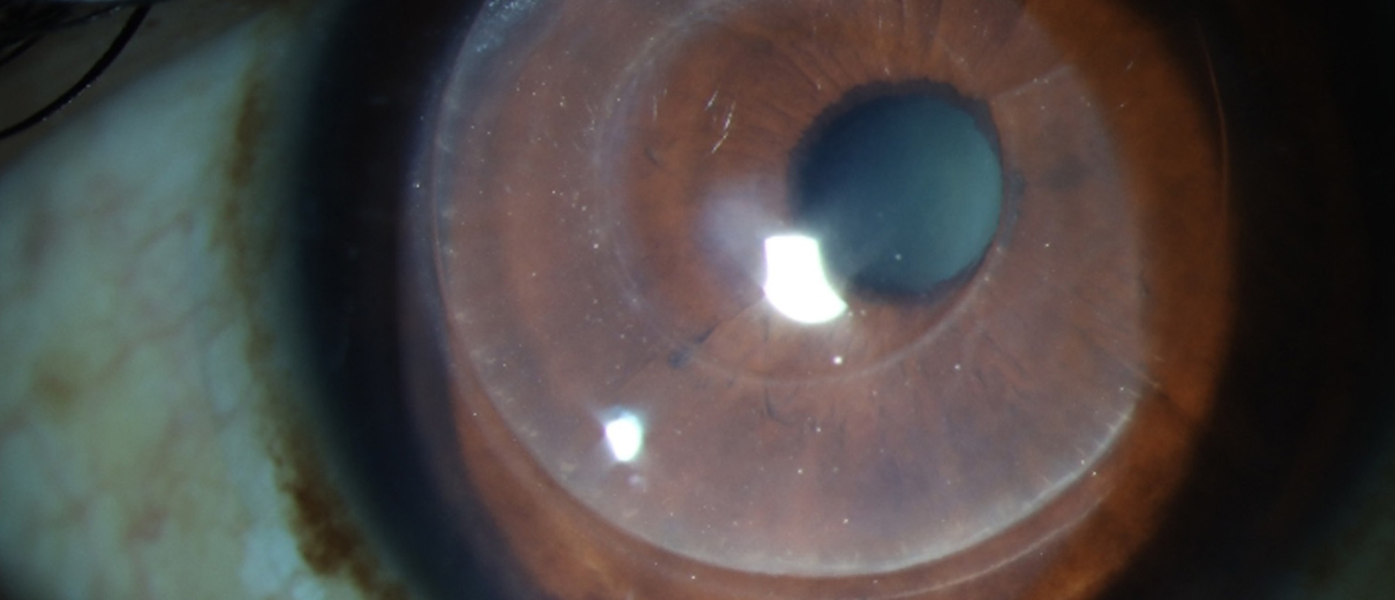 Keratoconus