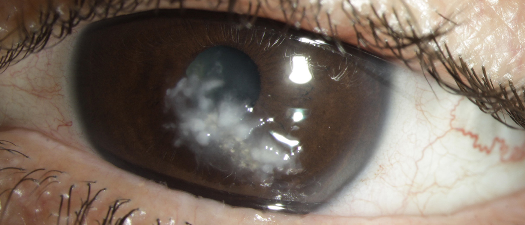 Secondary Corneal Amyloidosis