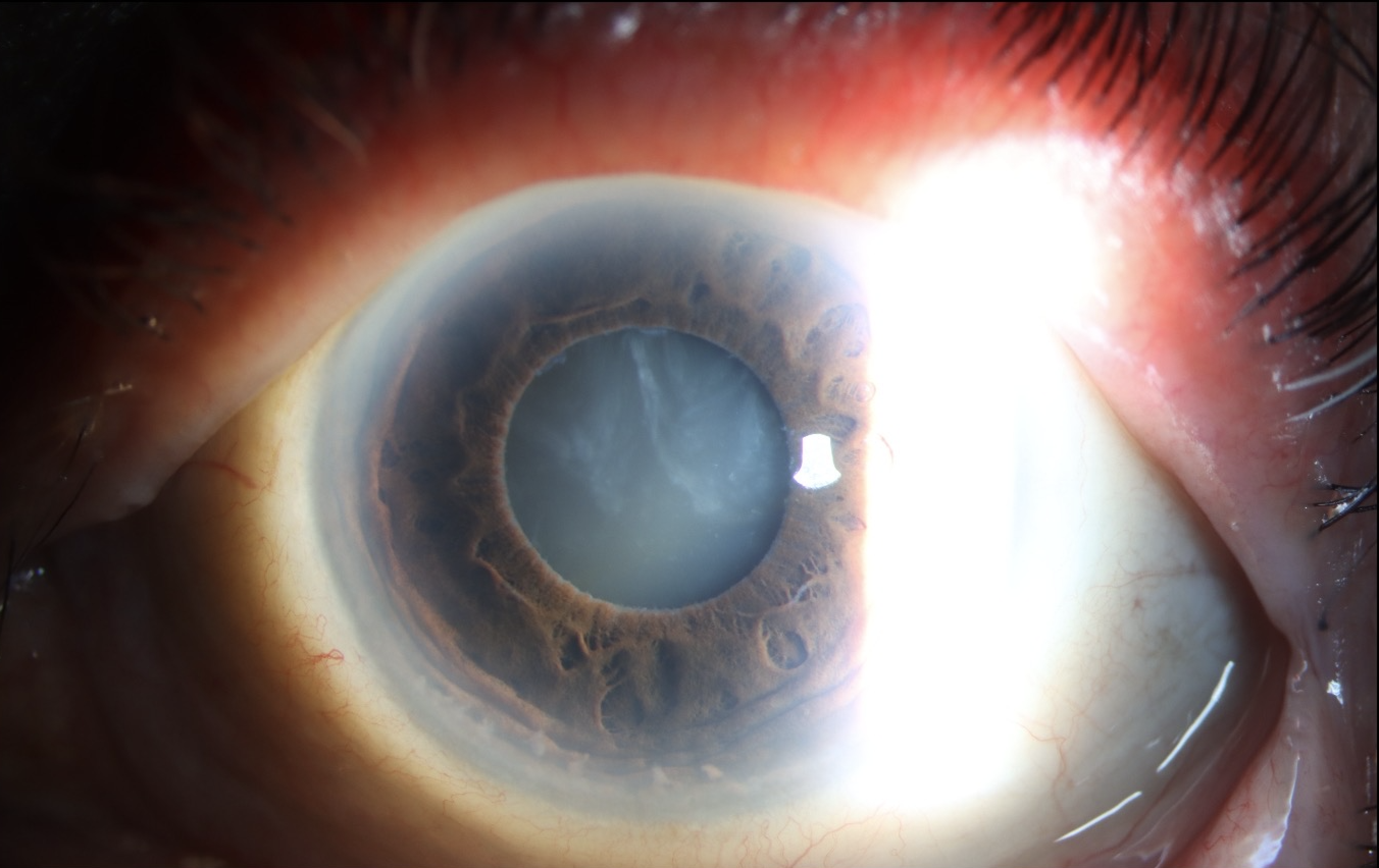 Morgagnian Cataract, Pseudoexfoliation Syndrome, Phacolytic Glaucoma
