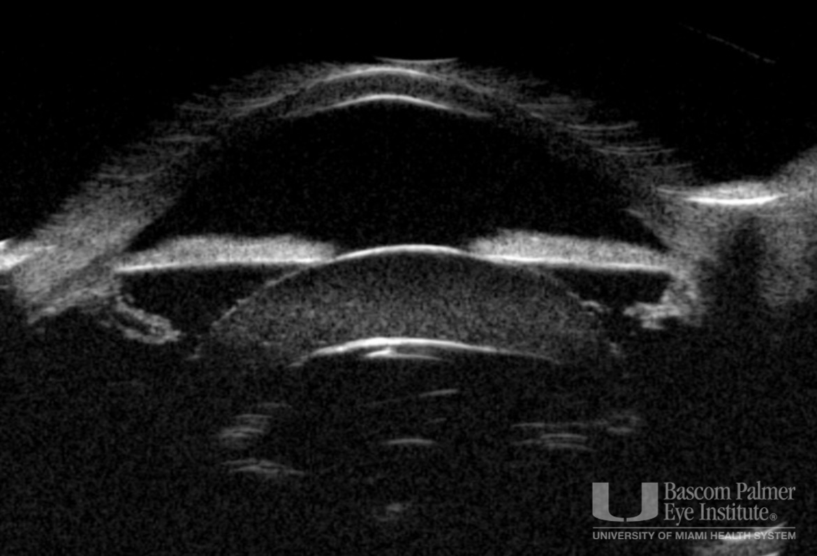 Morgagnian Cataract, Pseudoexfoliation Syndrome, Phacolytic Glaucoma