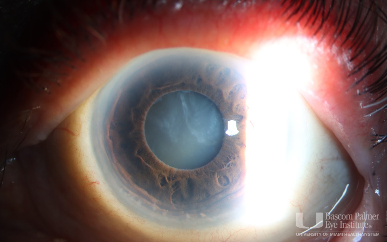 Morgagnian Cataract, Pseudoexfoliation Syndrome, Phacolytic Glaucoma