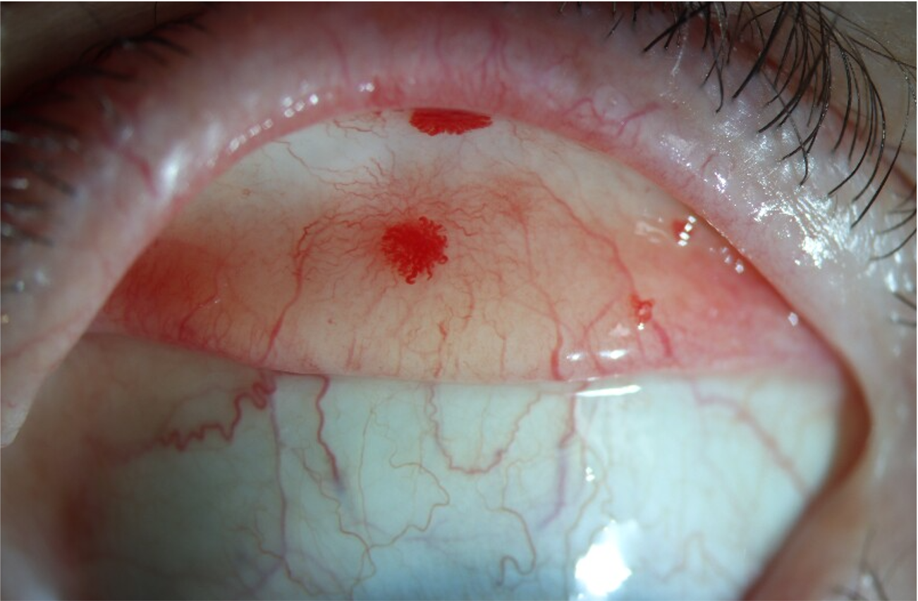 Tarsal Telangiectasia Secondary to Hereditary Hemorrhagic Telangiectasia (Osler–Weber–Rendu Syndrome)