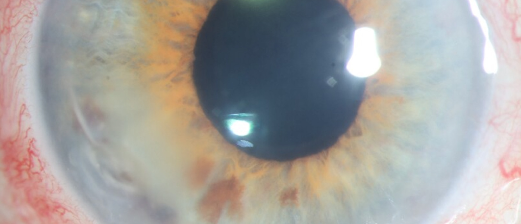 Mycobacterial Keratitis