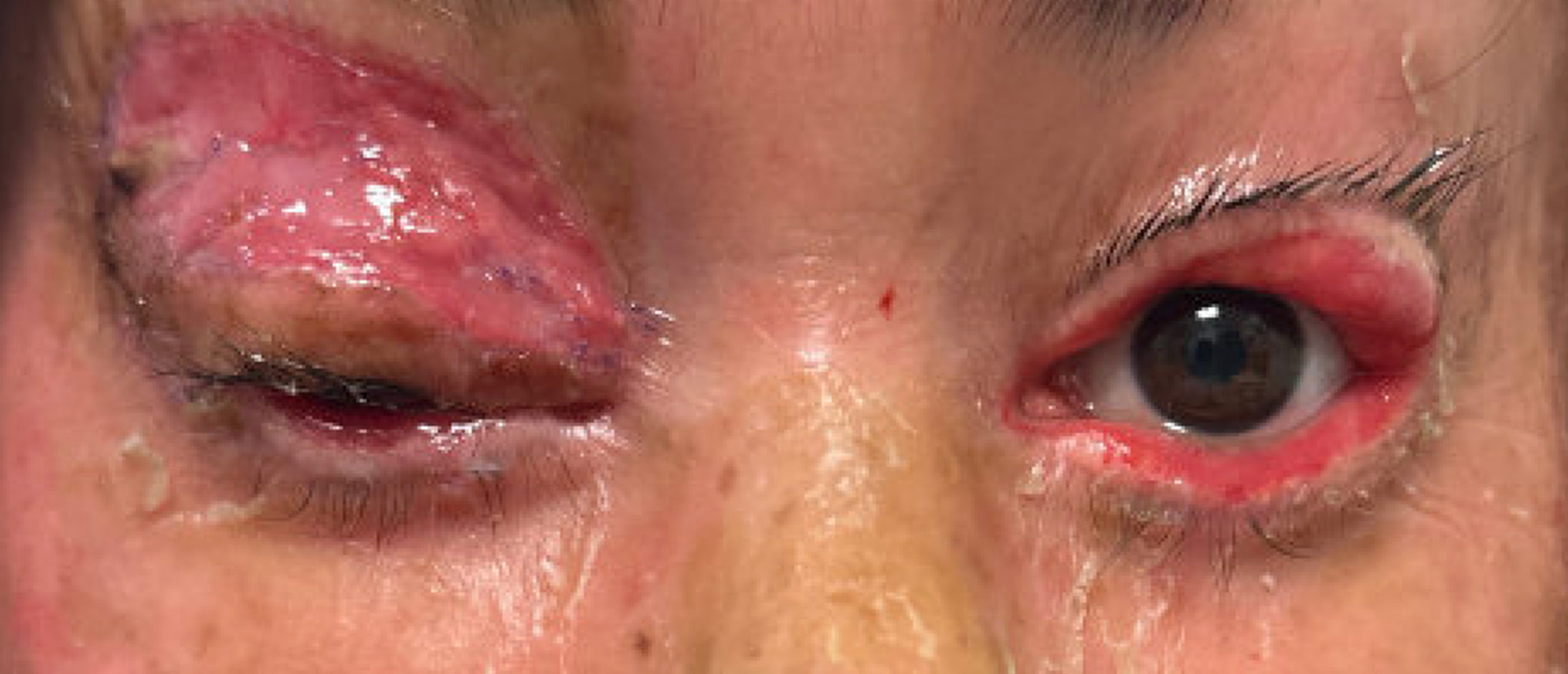 Cicatricial Ectropion Secondary to Lamellar Ichthyosis