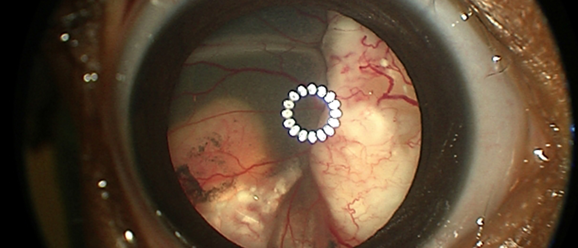 Bilateral Retinoblastoma