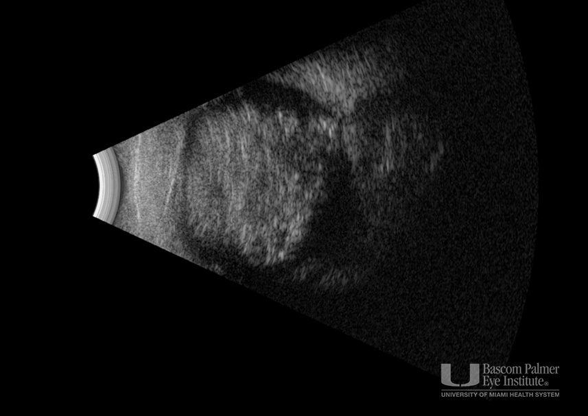 Bilateral Retinoblastoma