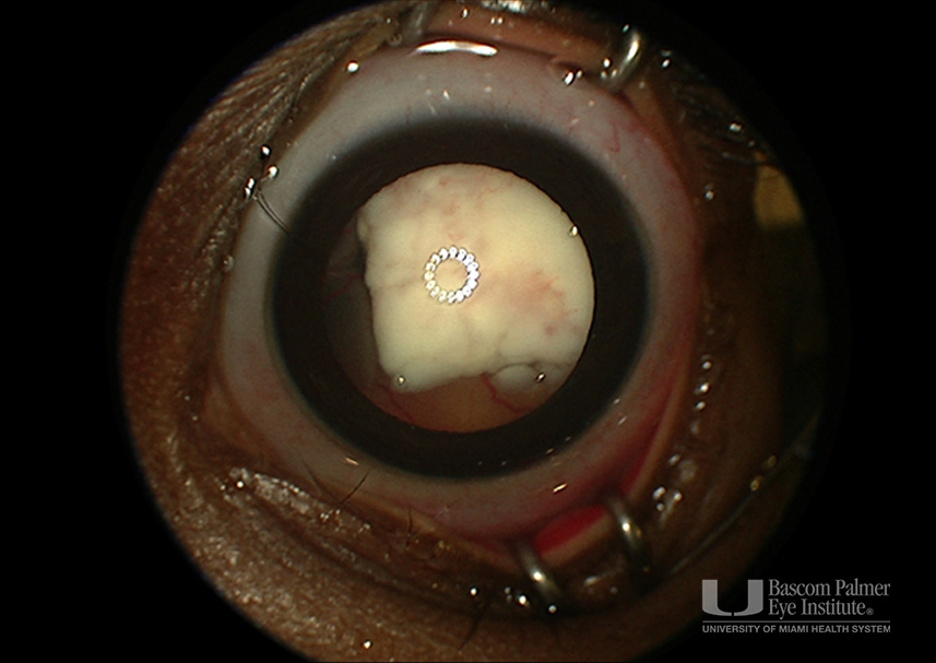 Bilateral Retinoblastoma