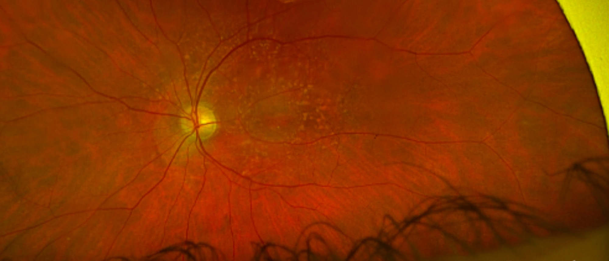 OCT, FAF, Fundus Photos for Subcutaneous Pentosan Polysulfate Maculopathy