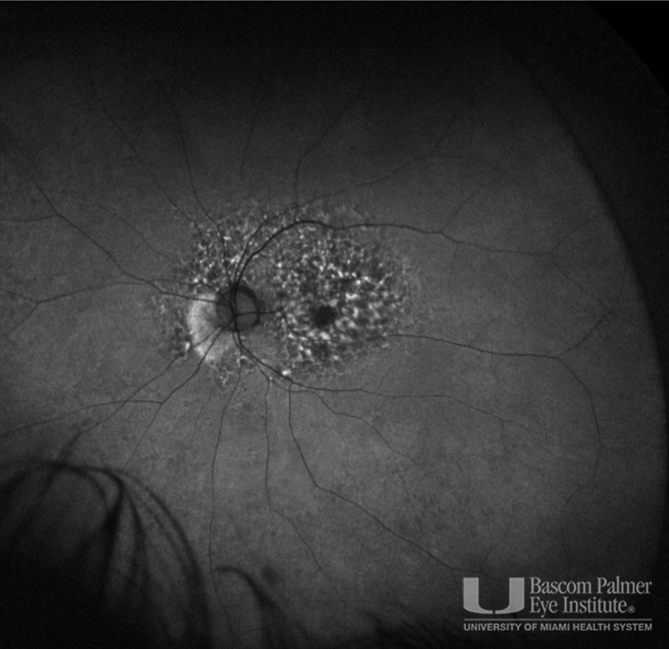 OCT, FAF, Fundus Photos for Subcutaneous Pentosan Polysulfate Maculopathy