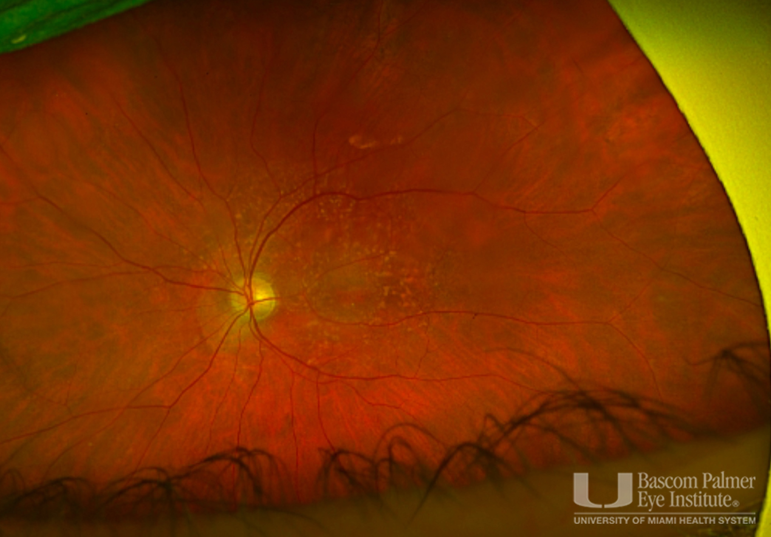 OCT, FAF, Fundus Photos for Subcutaneous Pentosan Polysulfate Maculopathy