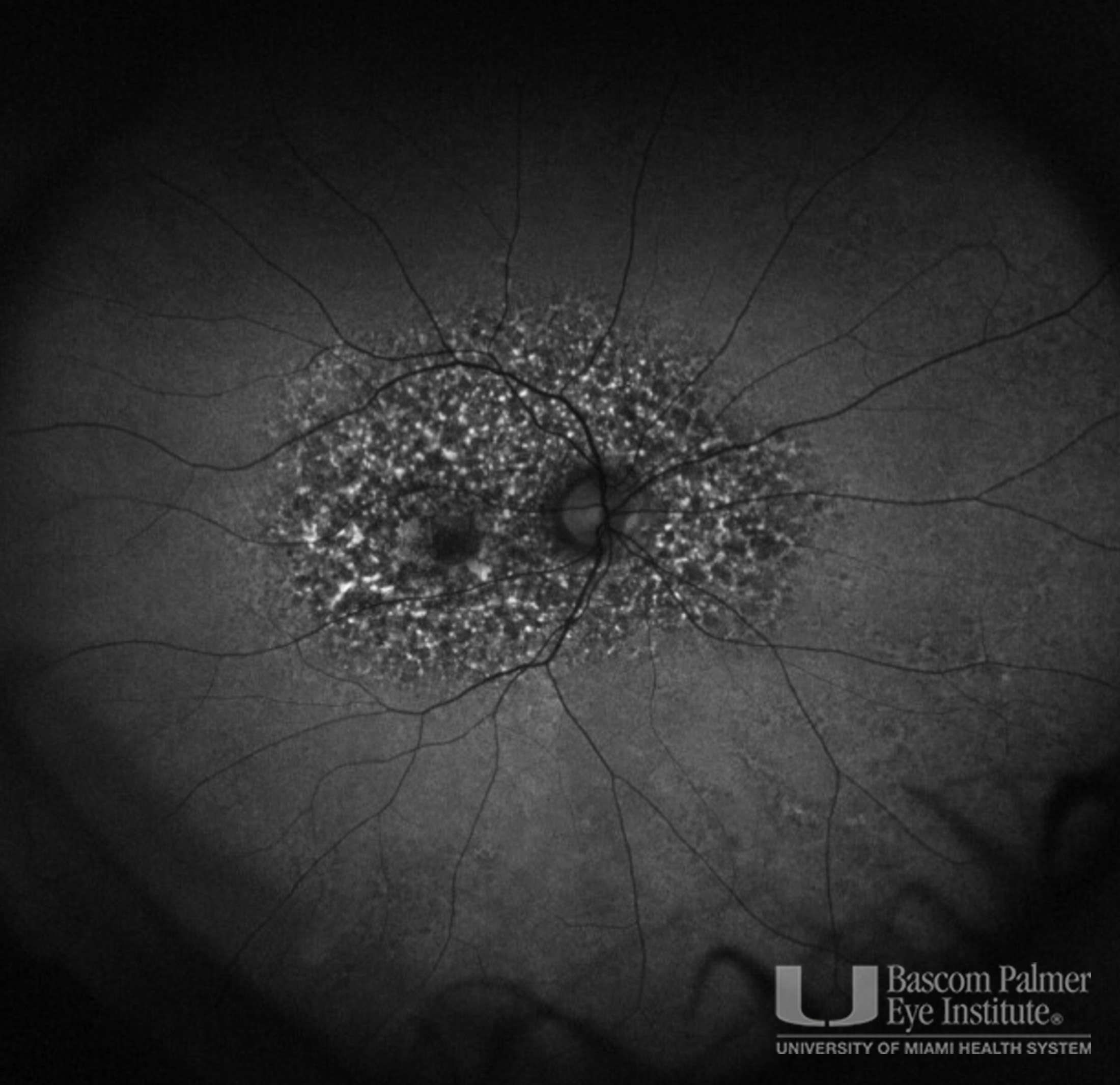 OCT, FAF, Fundus Photos for Subcutaneous Pentosan Polysulfate Maculopathy