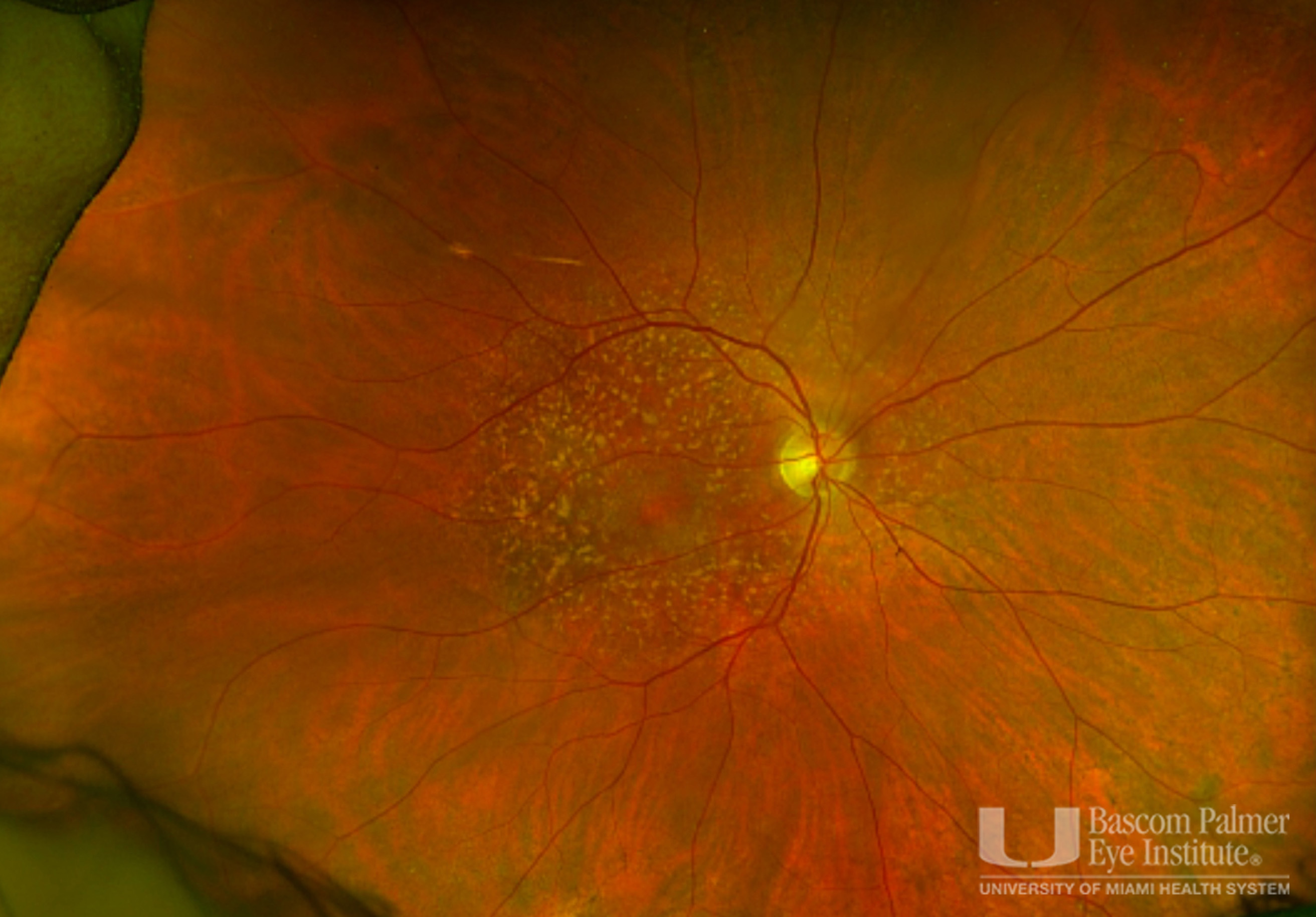 OCT, FAF, Fundus Photos for Subcutaneous Pentosan Polysulfate Maculopathy