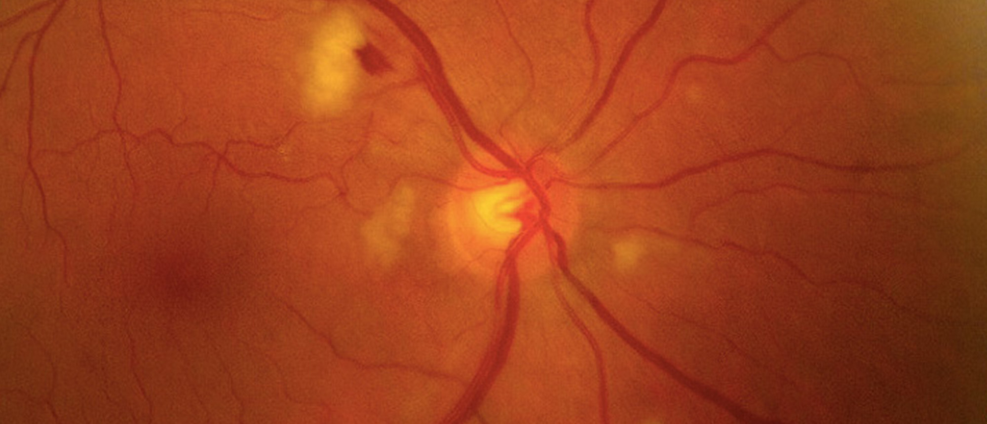 Gemcitabine Induced Purtscher Like Retinopathy in Both Eyes