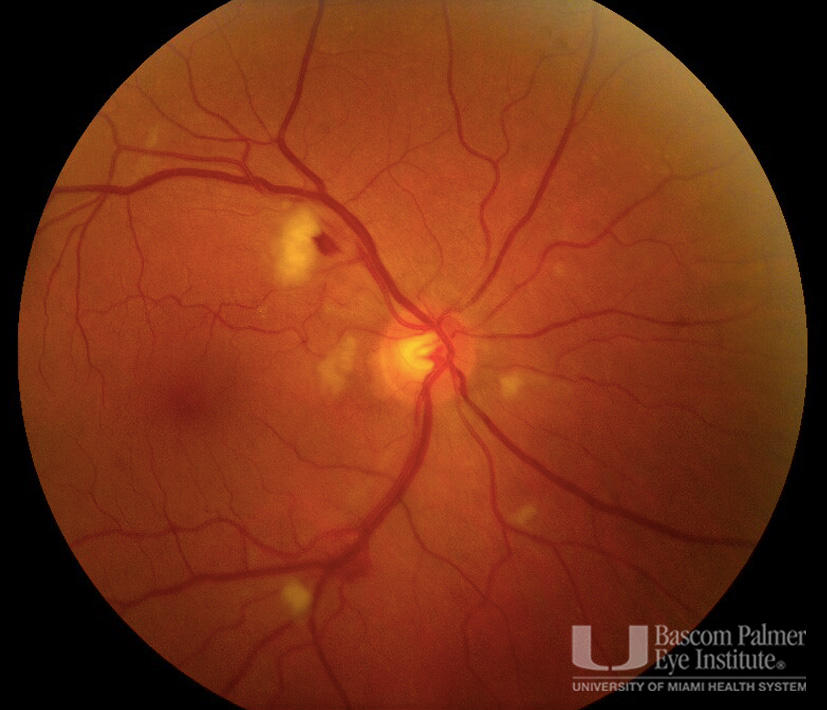 Gemcitabine induced Purstchers like retinopathy in both eyes